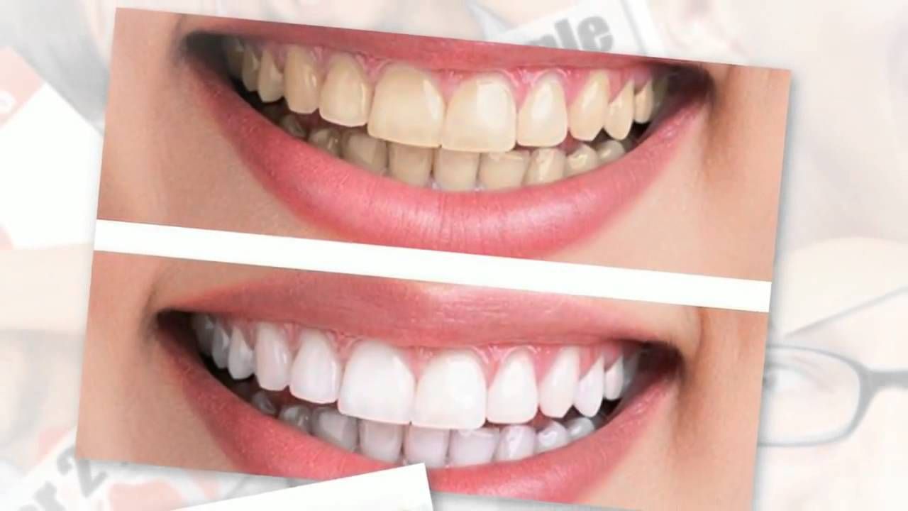 Benefits of Teeth Whitening