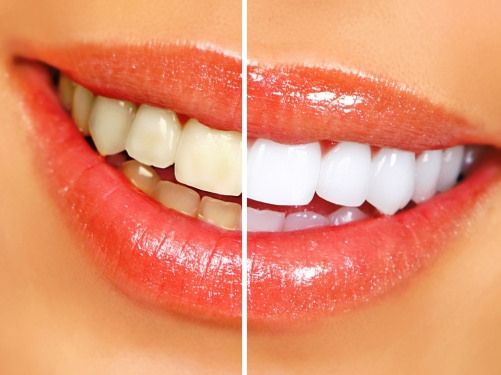 teeth whitening in florida