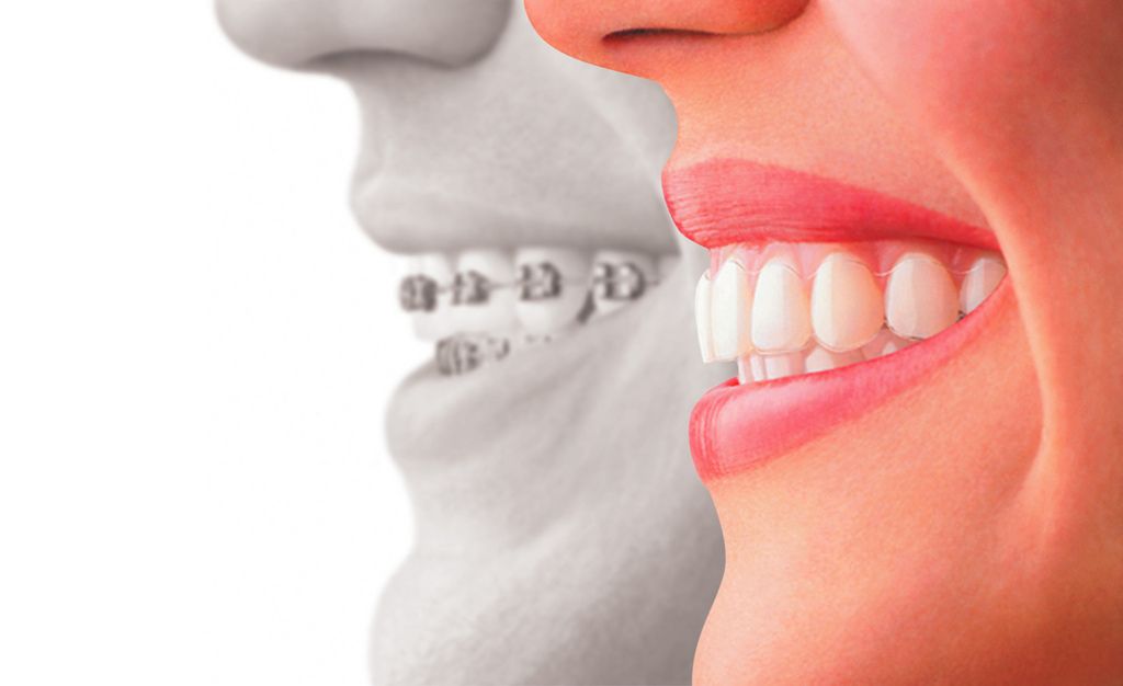 traditional braces vs invisalign
