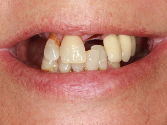 multiple missing teeth