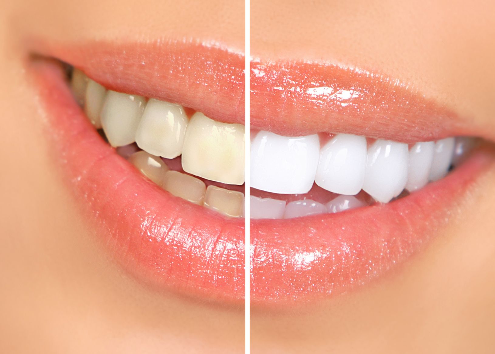 smile makeover