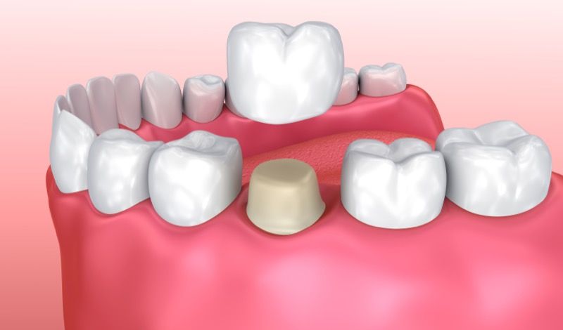Dental Crown