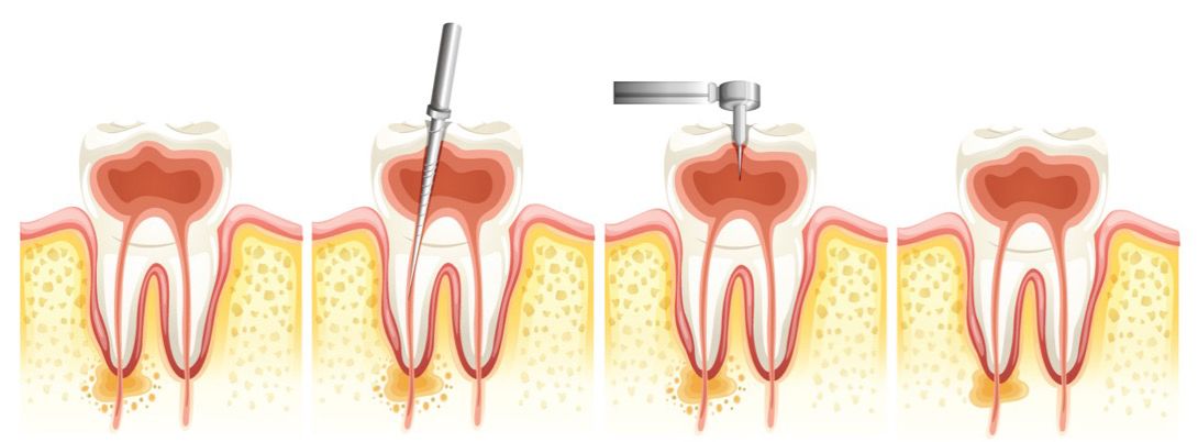 Root Canal Process