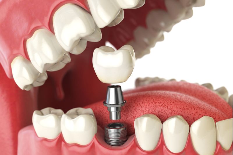 dental implants vero beach
