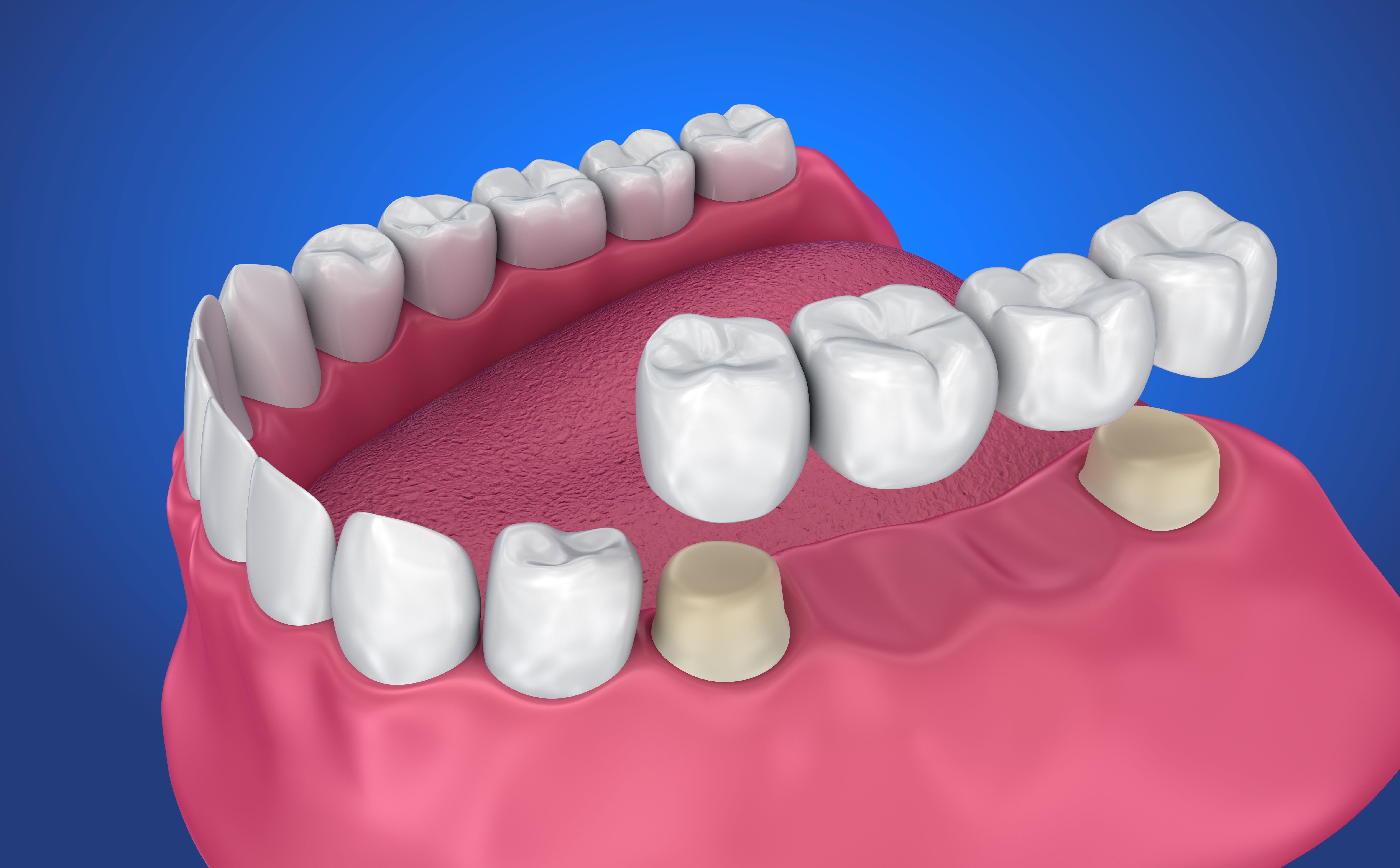 dental crowns