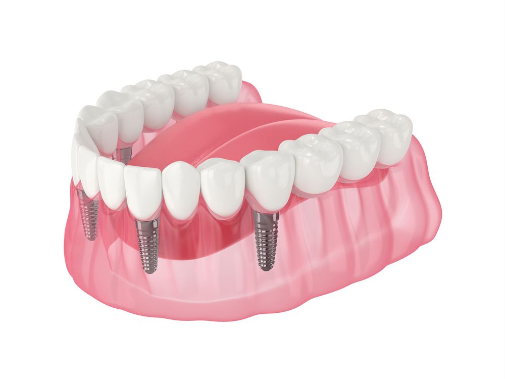 7 Reasons to Fix Teeth with Dental Implants