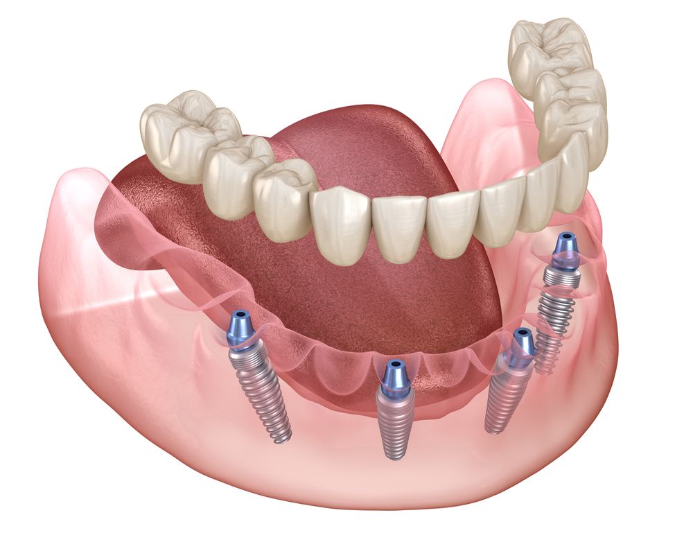 Are You a Candidate for Dental Implants? Find Out Here