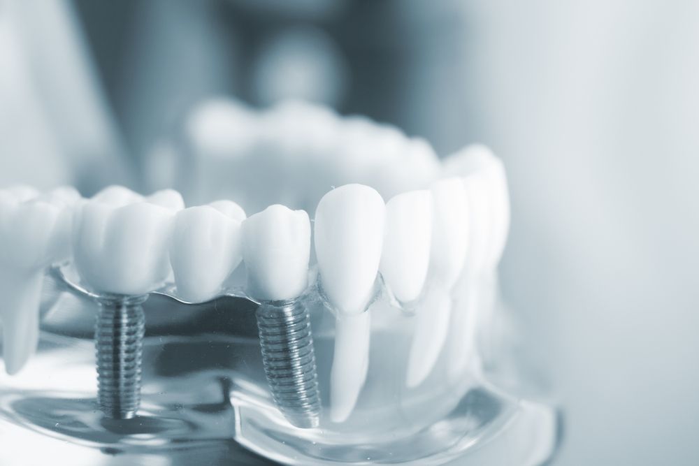 How Are Dental Implants Attached to the Gums?