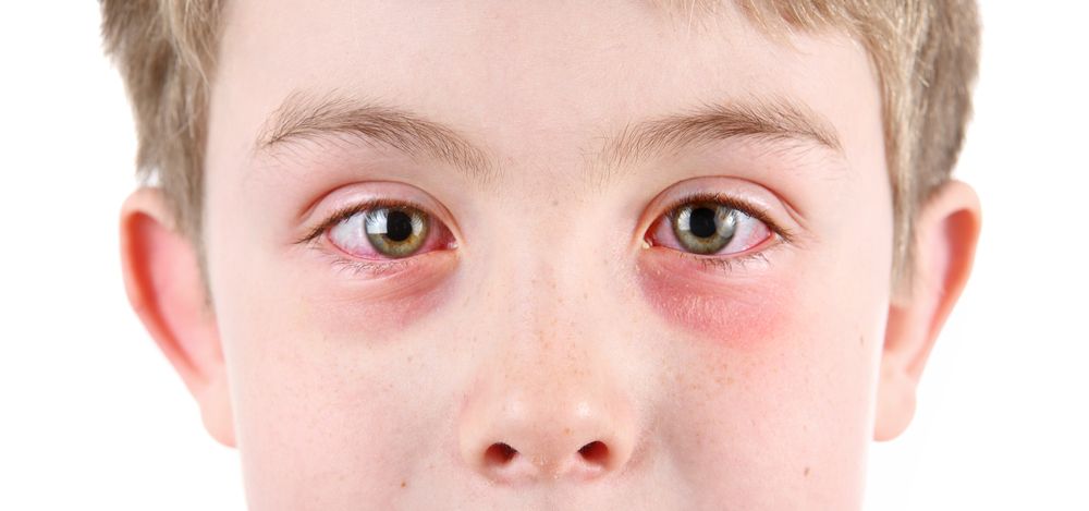 Eye Infections in Children: What Parents Need to Know