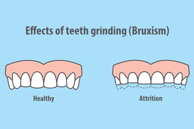 teeth grinding