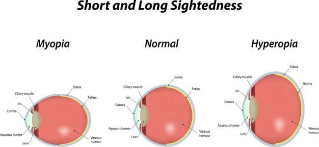 Nearsightedness Vs. Farsightedness