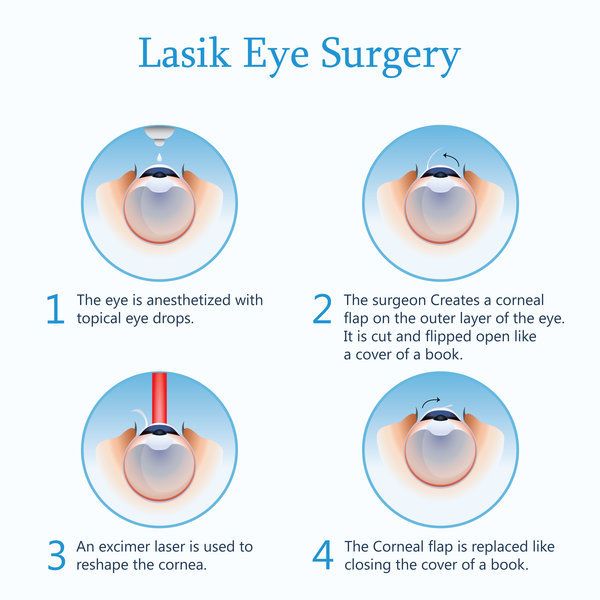 erreur de réfraction lasik