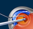 Cataract Surgery