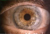 corneal transplants