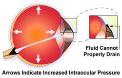 glaucoma eye