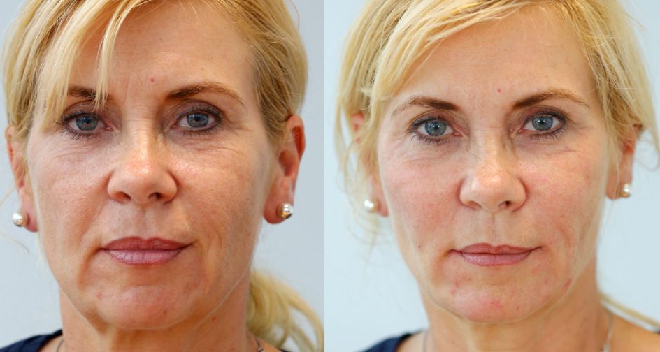 3D Non-Surgical Vector Facelift Before & After
