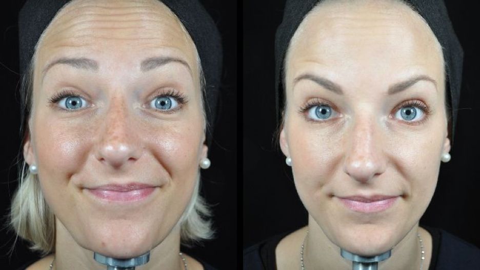 MesoBotox Baby Botox