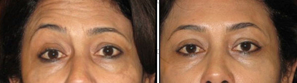 Nonsurgical Brow Lift with Botox