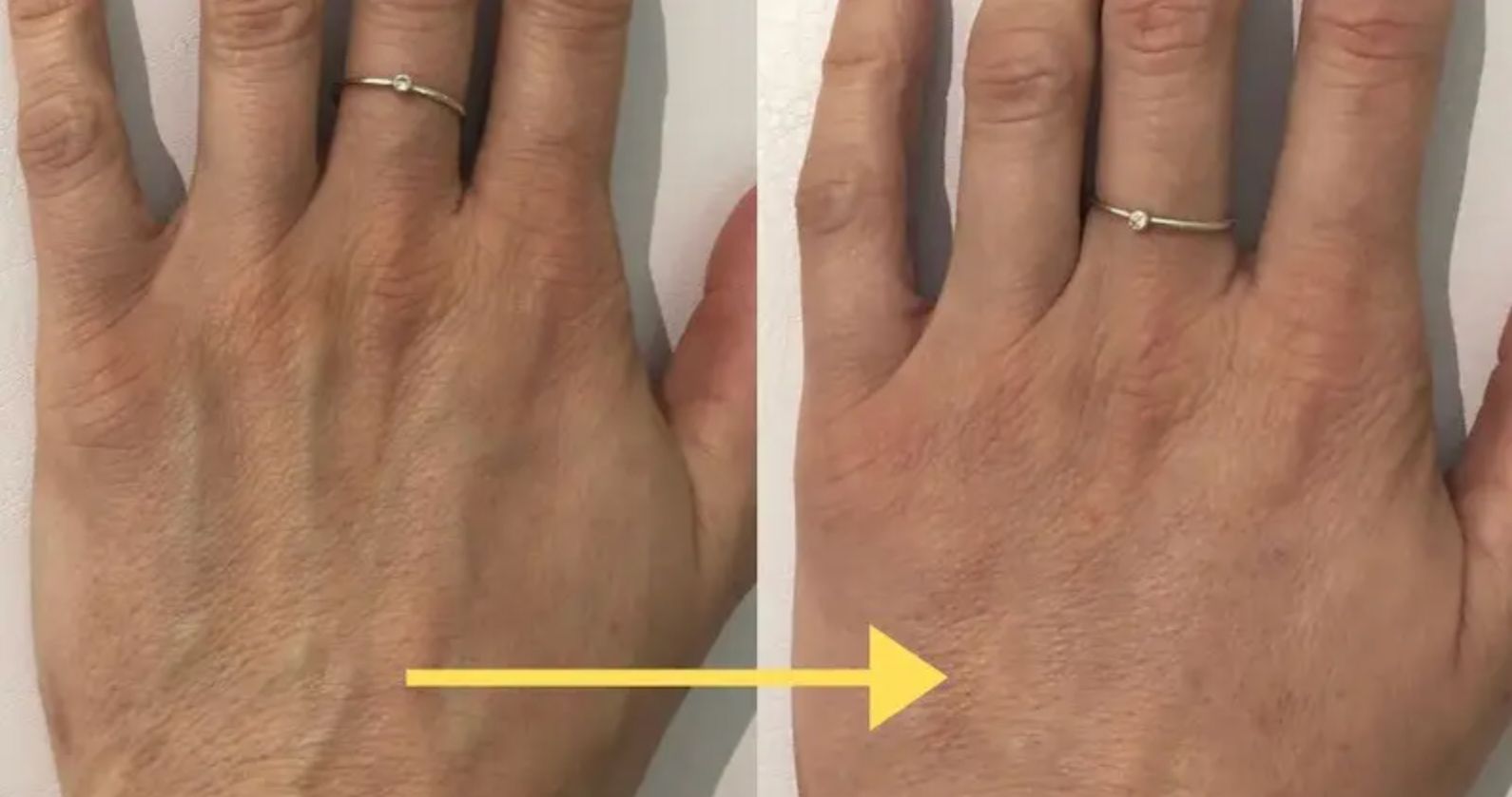 Dermal Fillers for Hand Rejuvenation