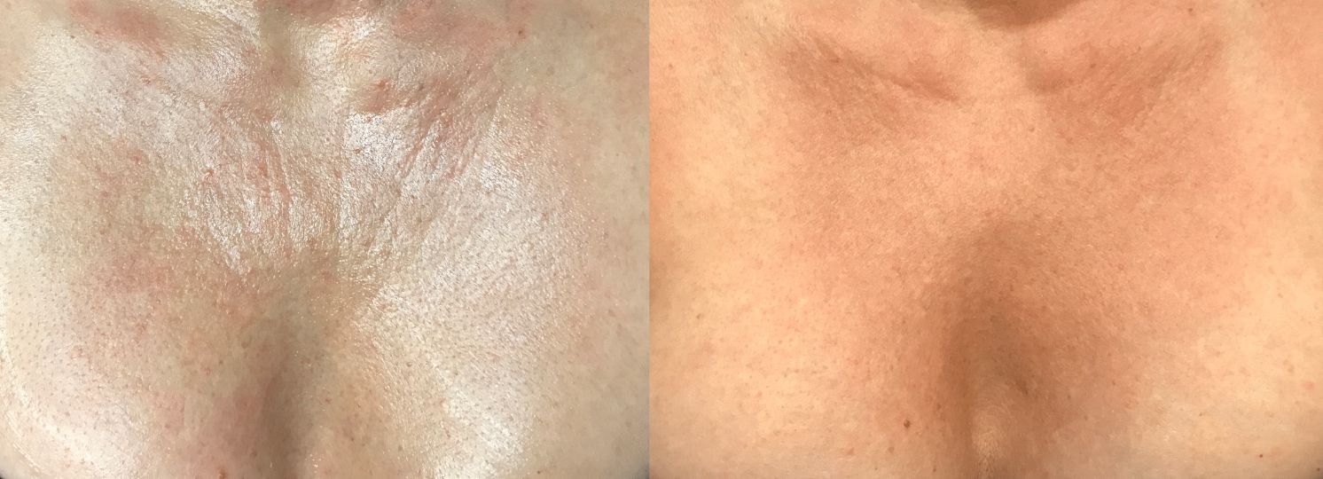 Pages / Decolette - Cleavage Chest Wrinkles