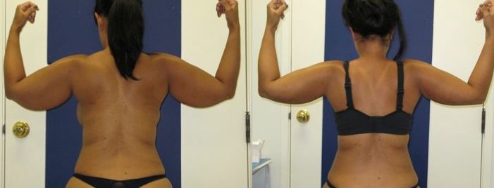 Arms Lipo Before & After