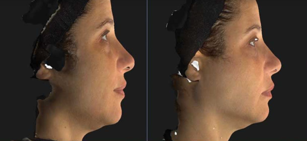 Botox Nefertiti Lift