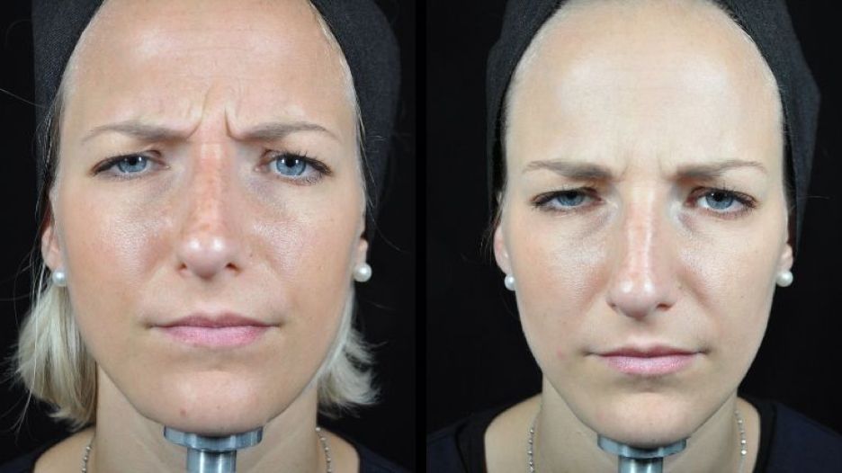MesoBotox Baby Botox