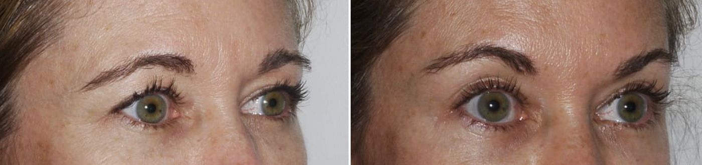 Nonsurgical Brow Lift with Botox
