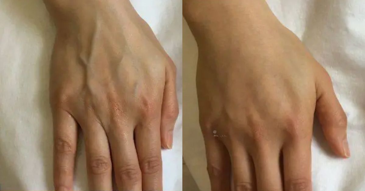 Dermal Fillers for Hand Rejuvenation