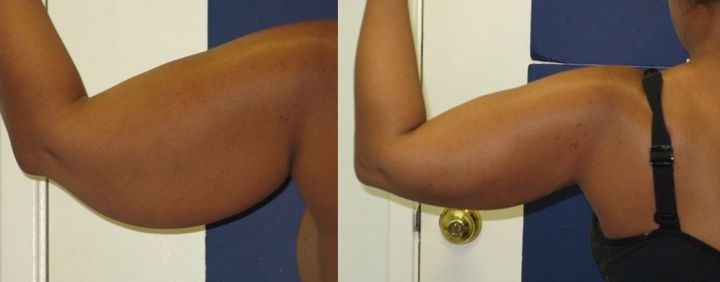 Arms Lipo Before & After