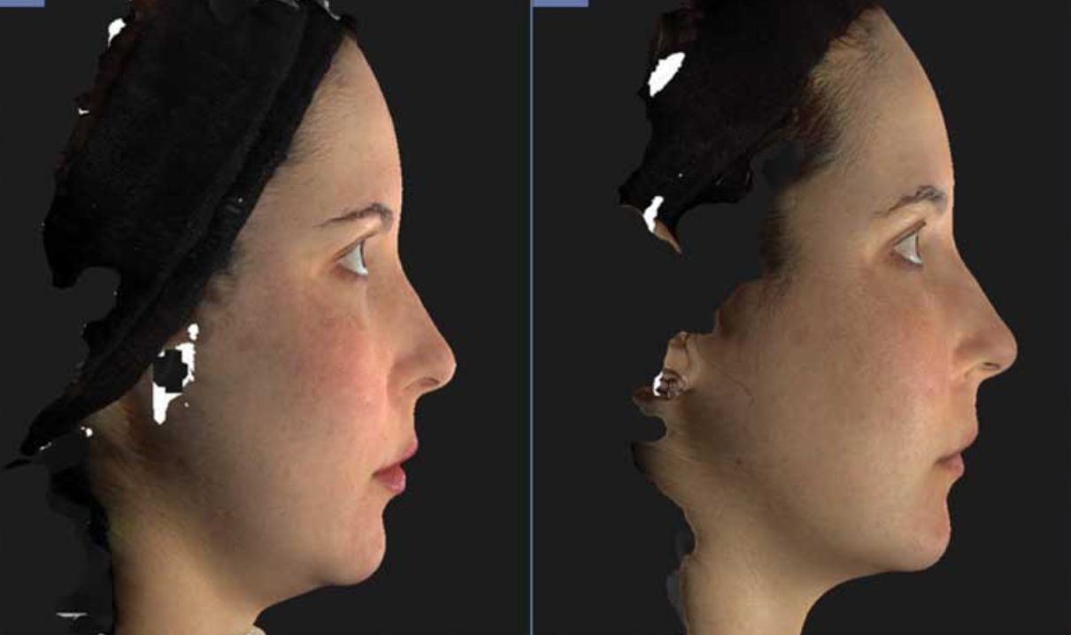 Botox Nefertiti Lift