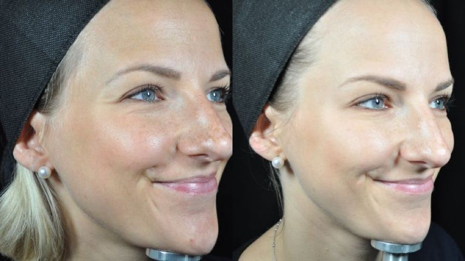 MesoBotox Baby Botox