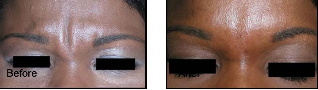Nonsurgical Brow Lift with Botox