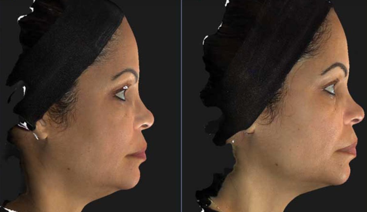 Botox Nefertiti Lift