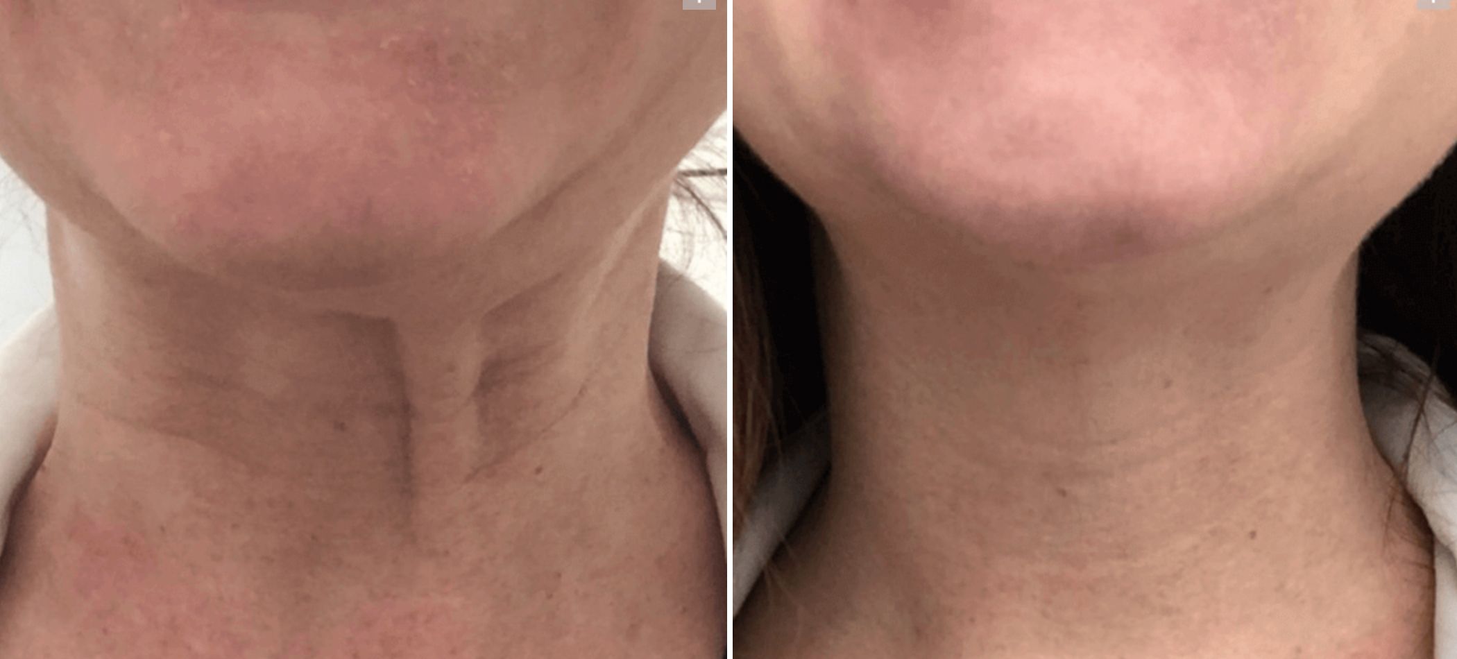 Botox for Turkey Neck and Neck Bands