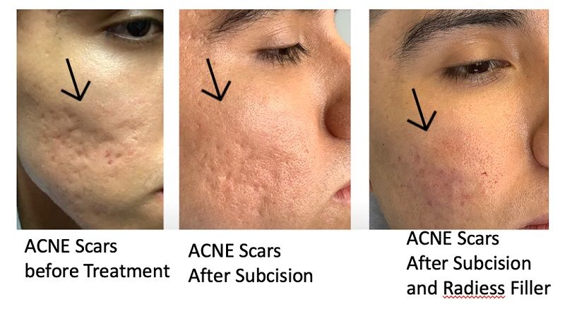 Subcision: