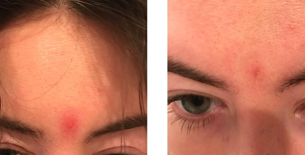 cystic acne