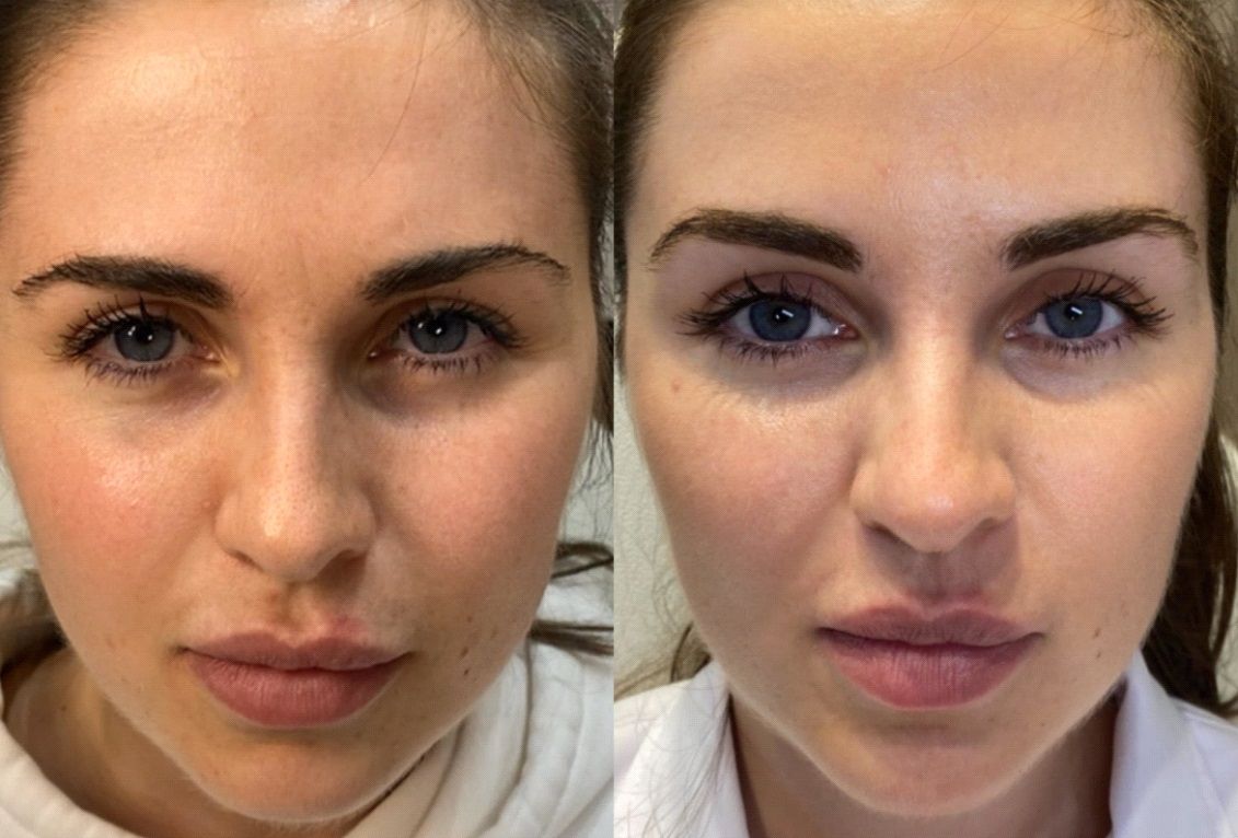 Dermal fillers