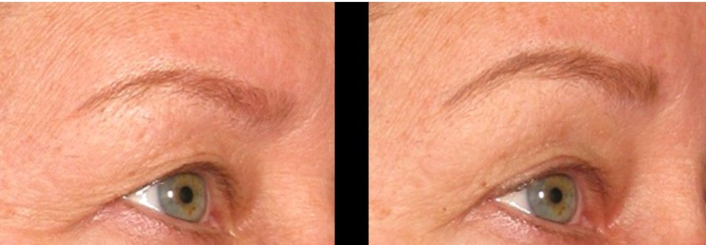 Reaction® VST Skin Tightening