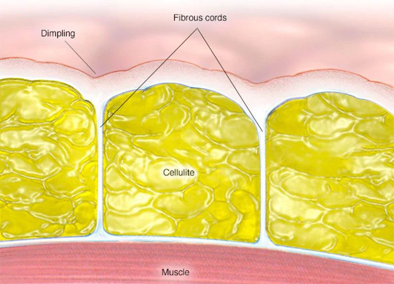 Cellulite
