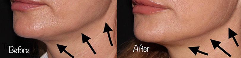 Botox Nefertiti Lift