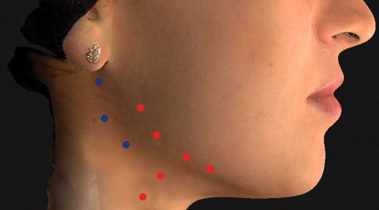 Botox Nefertiti Lift