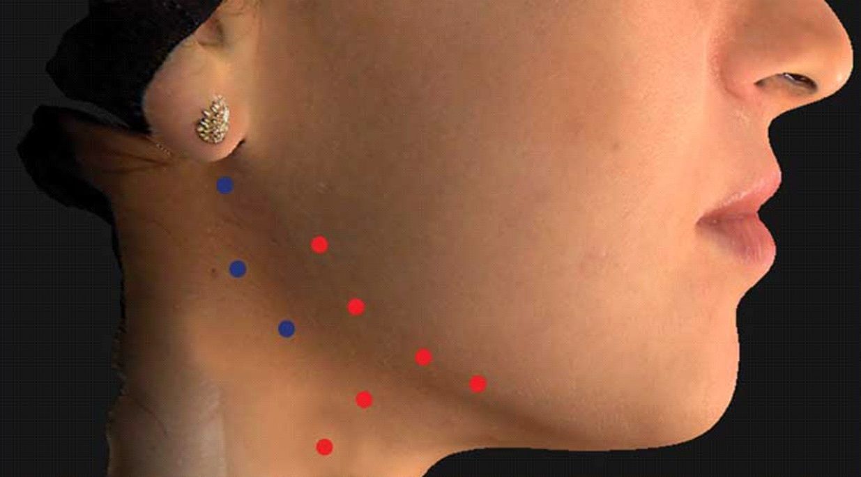 Neurotox For Nefertiti Neck Lift In Beverly Hills Ca