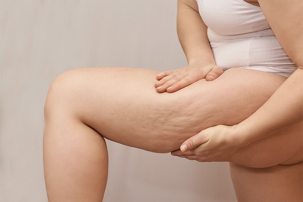 How to Get Rid of Cellulite With This Non-Surgical Treatment