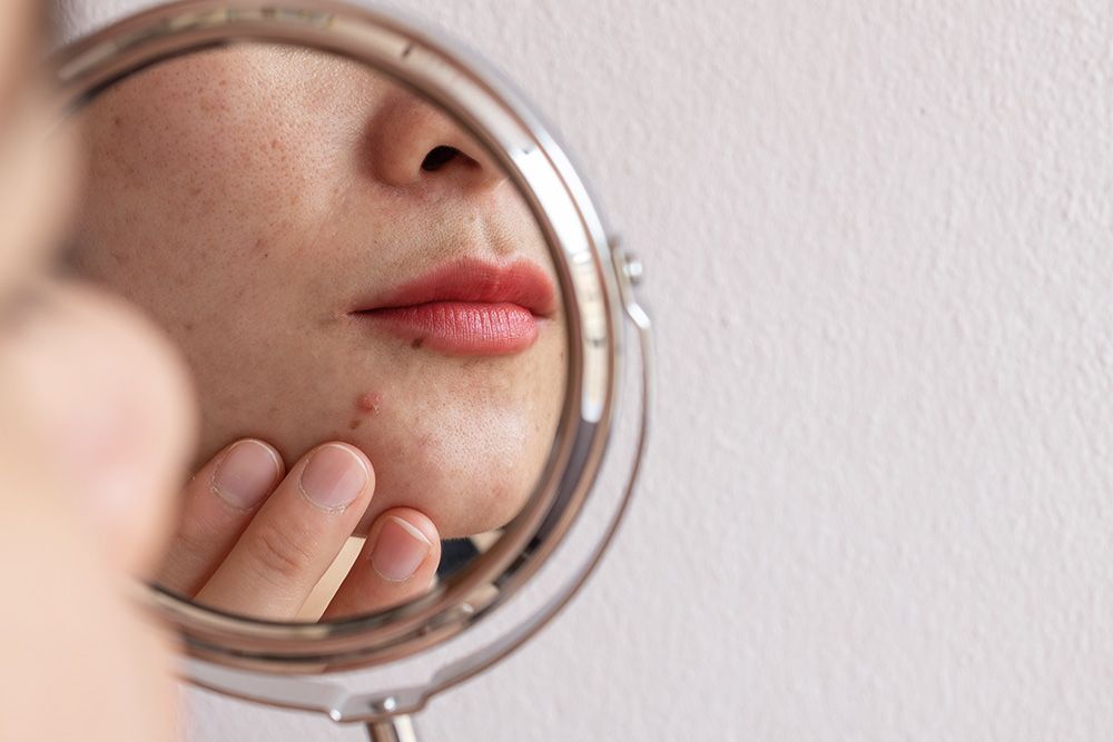 Can Botox Help With Acne?
