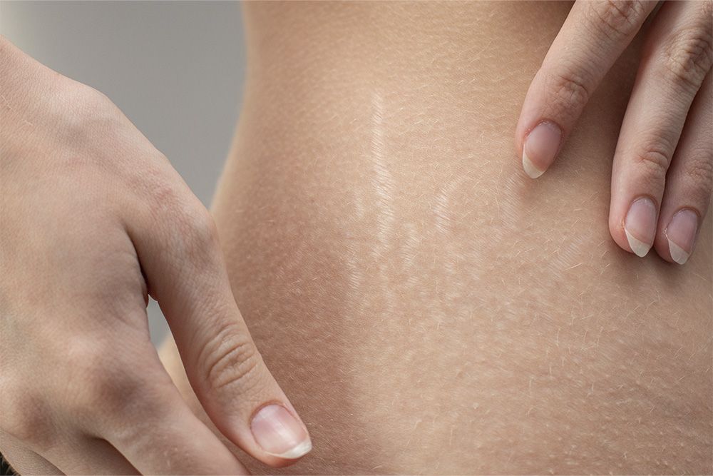 3 Ways to Diminish the Look of Stretch Marks