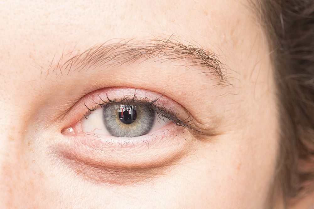 Get Rid of Dark Circles With One Non-Surgical Solution