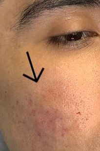 Subcision & Radiess Filler Acne Scar Treatment - After