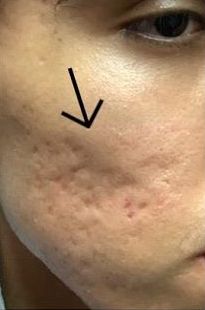 Subcision & Radiess Filler Acne Scar Treatment - Before