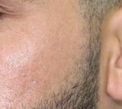 Nanofat Acne Scar Treatment - After